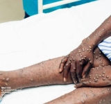 Stratégies adoptées par le ministère de la Santé pour la lutte contre la MPOX